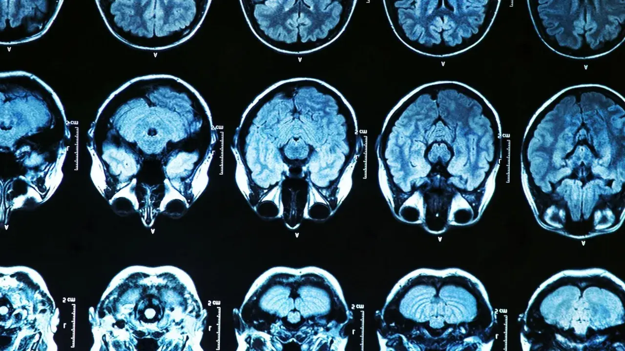 Przekroje mózgu na rezonansie magnetycznym. Badanie może pomóc w diagnostyce choroba parkinsona przyczyny.