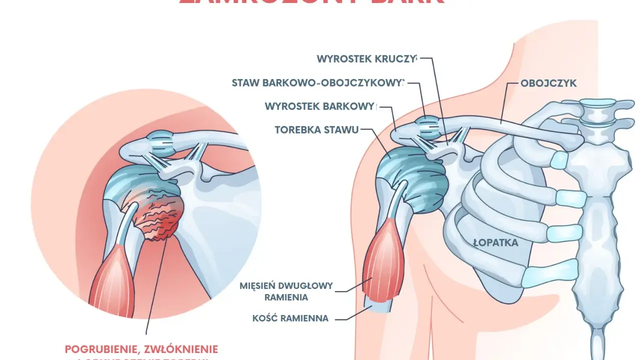 Anatomia barku z zaznaczonym mięśniem dwugłowym ramienia i pogrubioną torebką stawu, ilustracja problemu "zamrożonego barku".