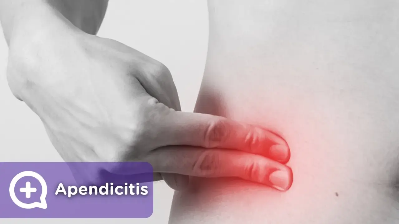 Apendicitis: ¿Dolor común o urgencia? Identifica los síntomas clave.