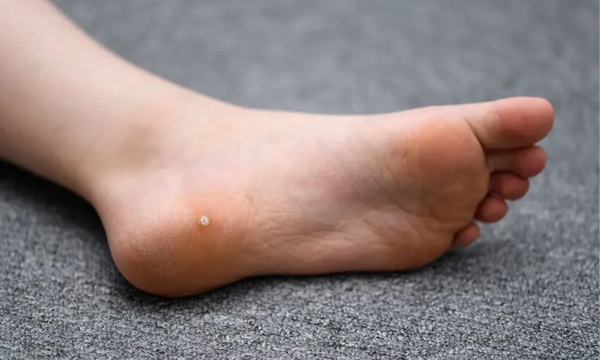 Piede con una piccola verruca inizio sul tallone, su sfondo grigio.