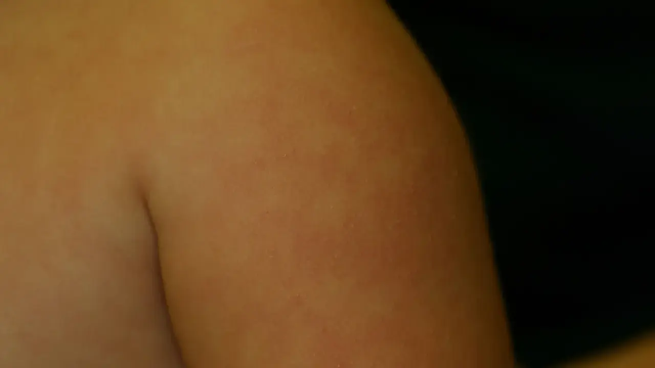 Éruption cutanée sur le bras, possiblement du pityriasis alba. Le traitement est souvent simple et vise à hydrater la peau.