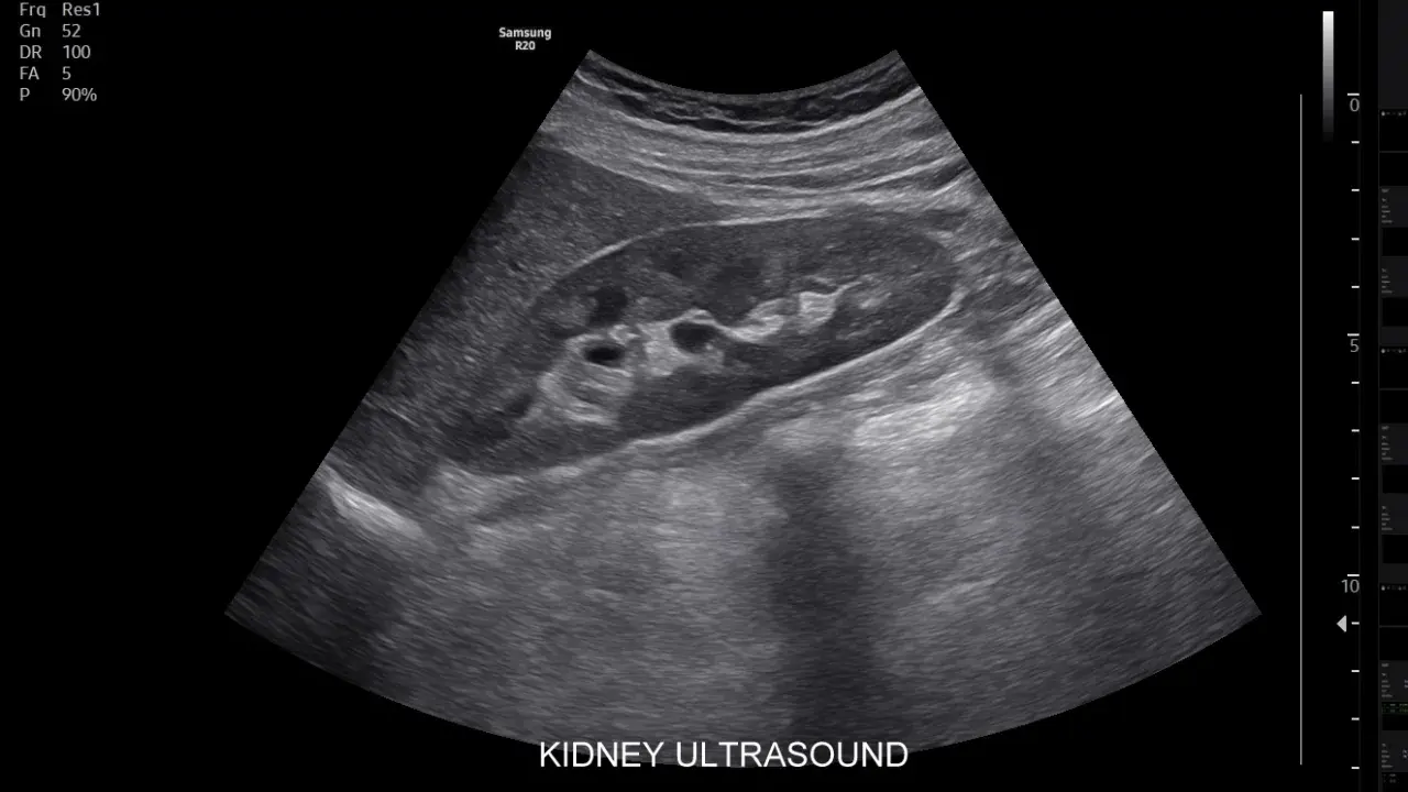 Obraz USG nerki. Czy usg jamy brzusznej wykryje raka? Badanie pokazuje strukturę nerki, pomagając w diagnostyce.