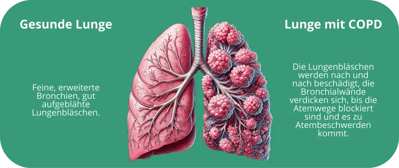 Vergleich von gesunder Lunge und Lunge mit COPD. Die COPD-Lunge zeigt geschädigte Lungenbläschen und verdickte Bronchien, was zu Atemnot führt, auch ohne Husten.