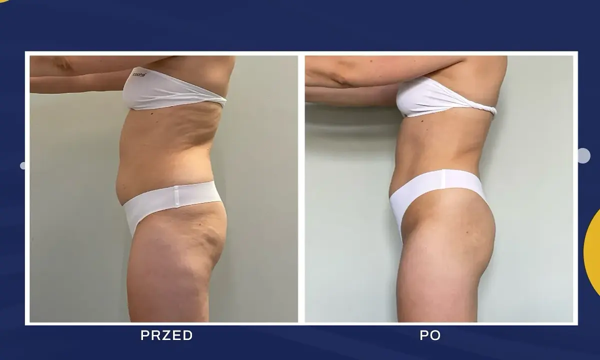 Liposukcja: Modelowanie sylwetki czy odchudzanie? Poznaj prawdę