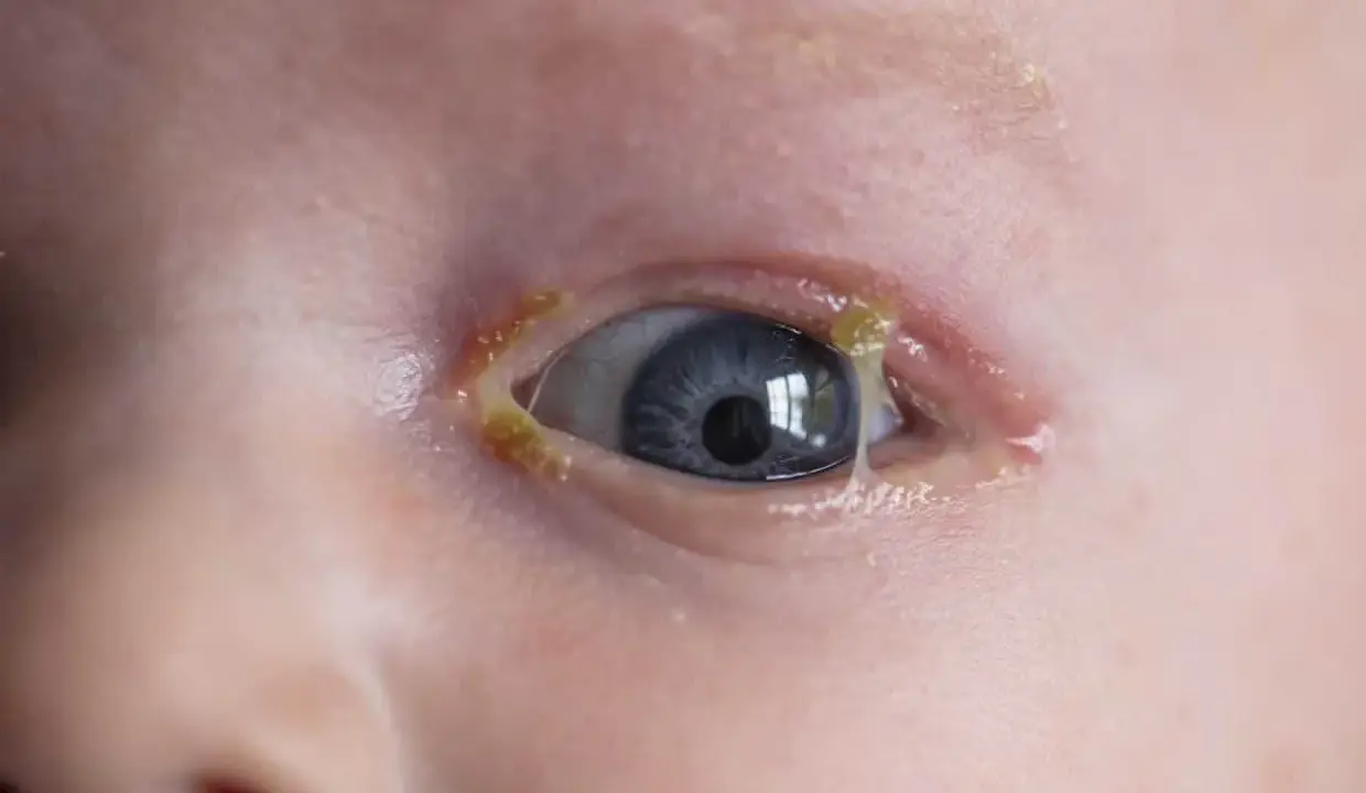 Occhio di bambino con secrezioni giallastre, sintomo di congiuntivite.