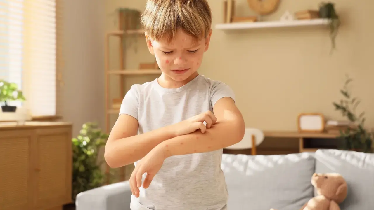 Niño con varicela en brazos y cara, rascándose el brazo.