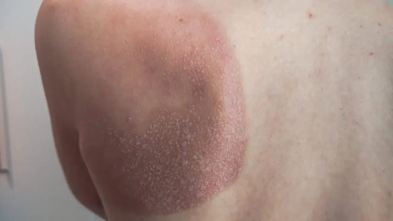 Une petite cloque d'eau sur la peau, signe d'un coup de soleil. La zone affectée est rouge et légèrement écailleuse.