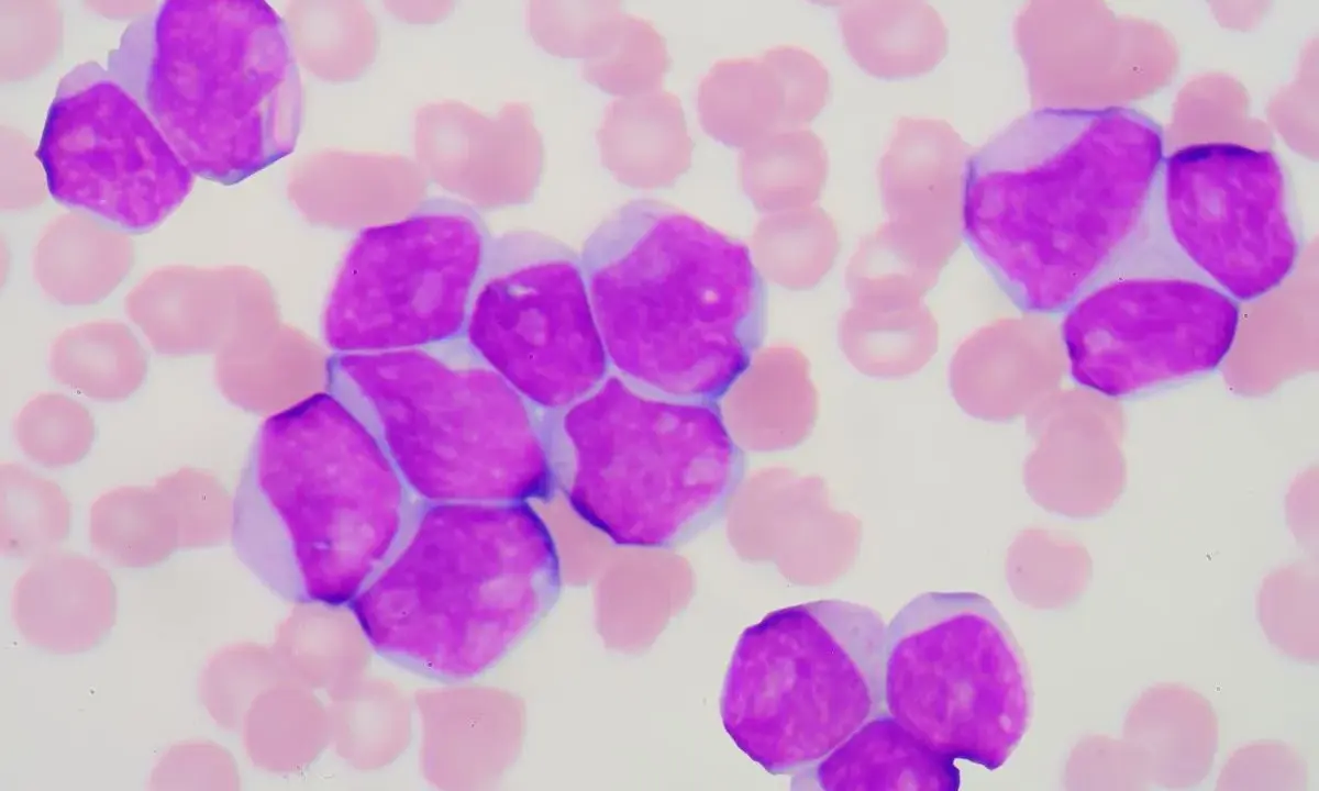 Cellule immature viola, indicative di leucemia linfoblastica acuta, circondate da globuli rossi.