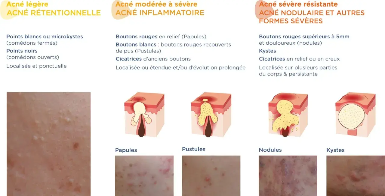 Schéma illustrant les différents types d'acné, des points blancs aux kystes, montrant l'évolution d'un bouton de puberté.