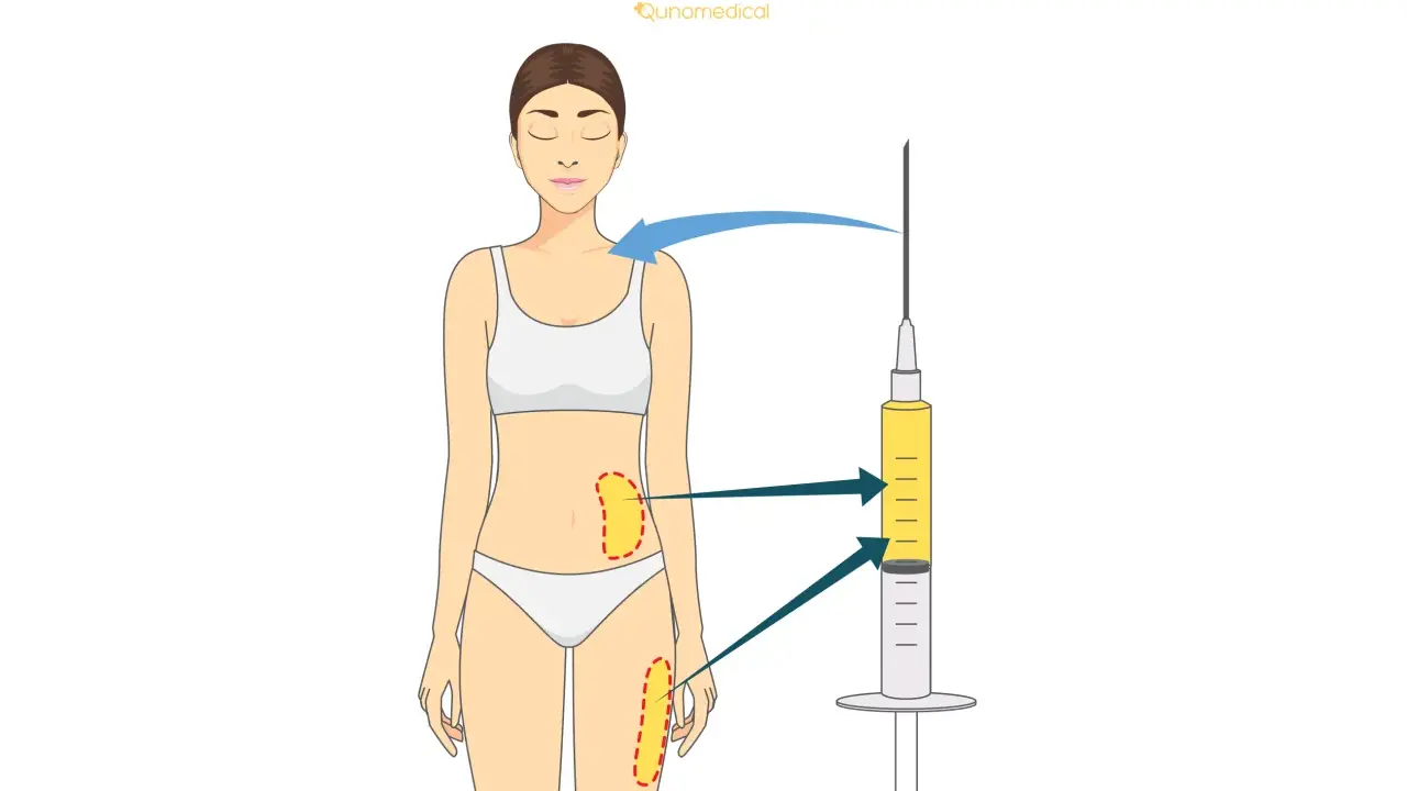 Illustrazione del lipofilling al seno: grasso prelevato da addome e cosce viene iniettato per aumentare il volume del seno.