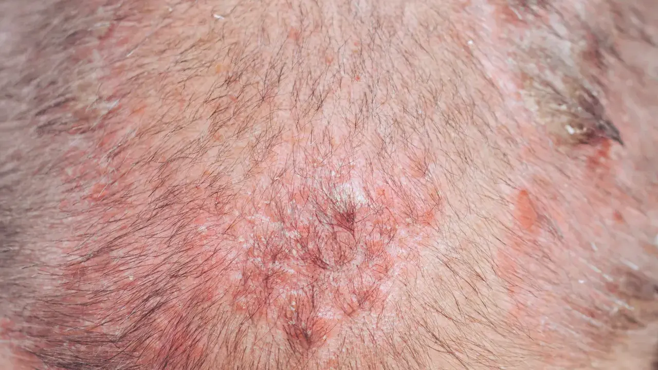 Primo piano del cuoio capelluto con arrossamenti e croste, tipici di condizioni cutanee che possono colpire gli anziani.