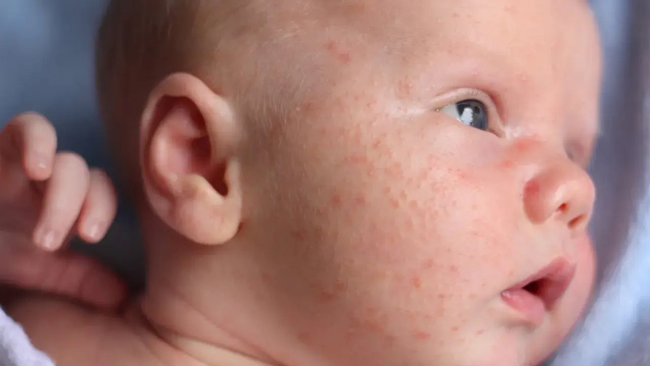 Nahaufnahme eines Babys mit roten Pickelchen im Gesicht. Die Frage "Babyakne wie lange" beschäftigt viele Eltern.