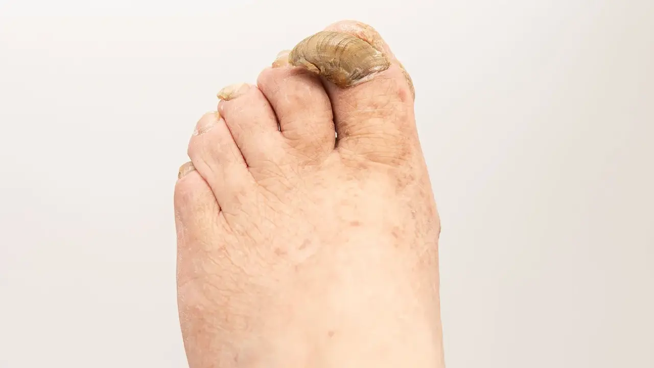 Primo piano di un piede con unghie dei piedi ispessite e scolorite, che suggerisce la necessità di rimedi per le unghie dei piedi ispessite.
