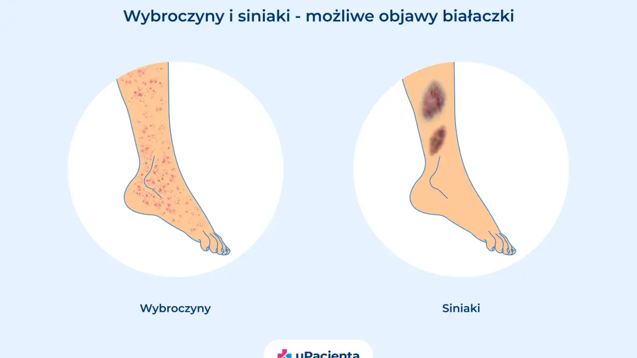 Wybroczyny i siniaki na nogach mogą być objawami białaczki szpikowej. Ilustracja pokazuje zmiany skórne.