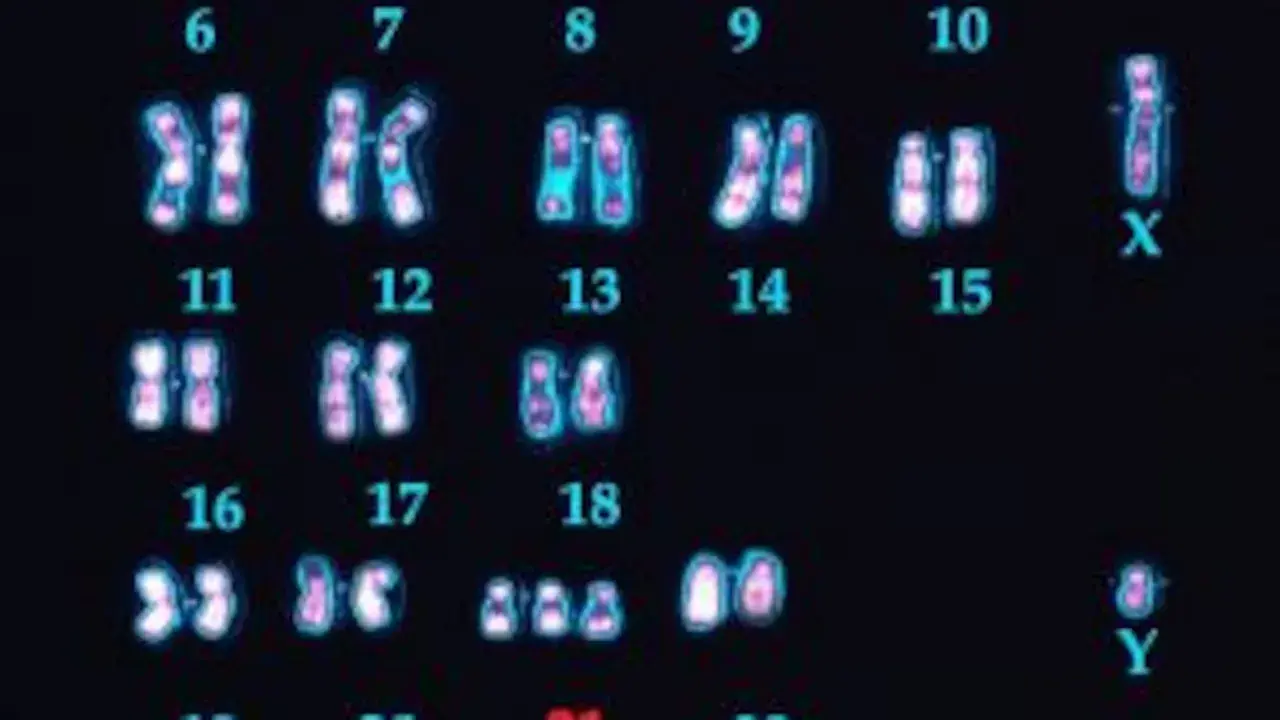 Cariotipo humano con 23 pares de cromosomas, incluyendo el par sexual X e Y. Se observan los cromosomas del 6 al 18, y el 21.