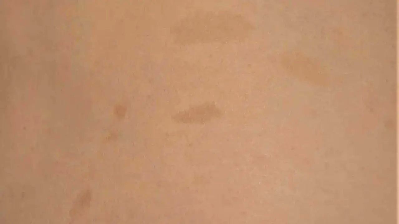 Macchie caffè latte sulla pelle, possibili indicatori di neurofibromatosi.