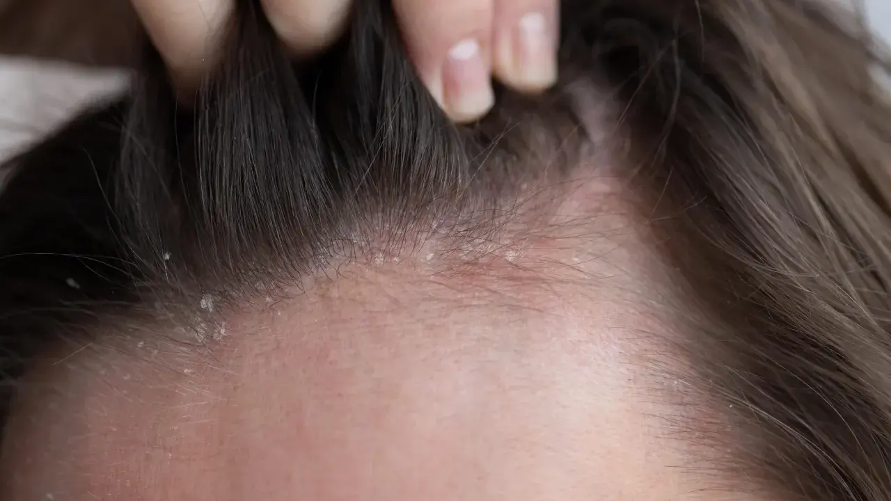 Une main soulève des mèches de cheveux, révélant des pellicules sur le cuir chevelu. Une pellicule enfant peut être une préoccupation pour les parents.