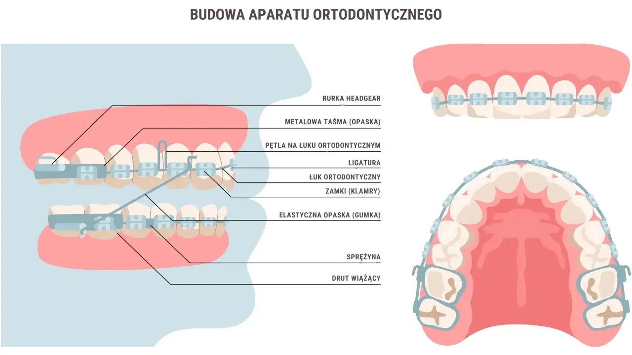 Ile nosi się aparat stały? Czas leczenia i jak go skrócić