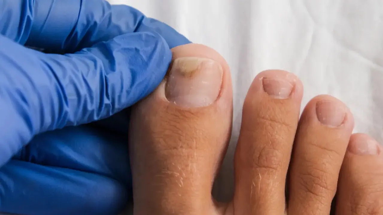 Main d'un podologue examinant un ongle de pied atteint de mycose. Renseignez-vous sur le tarif podologue mycose pour un traitement.