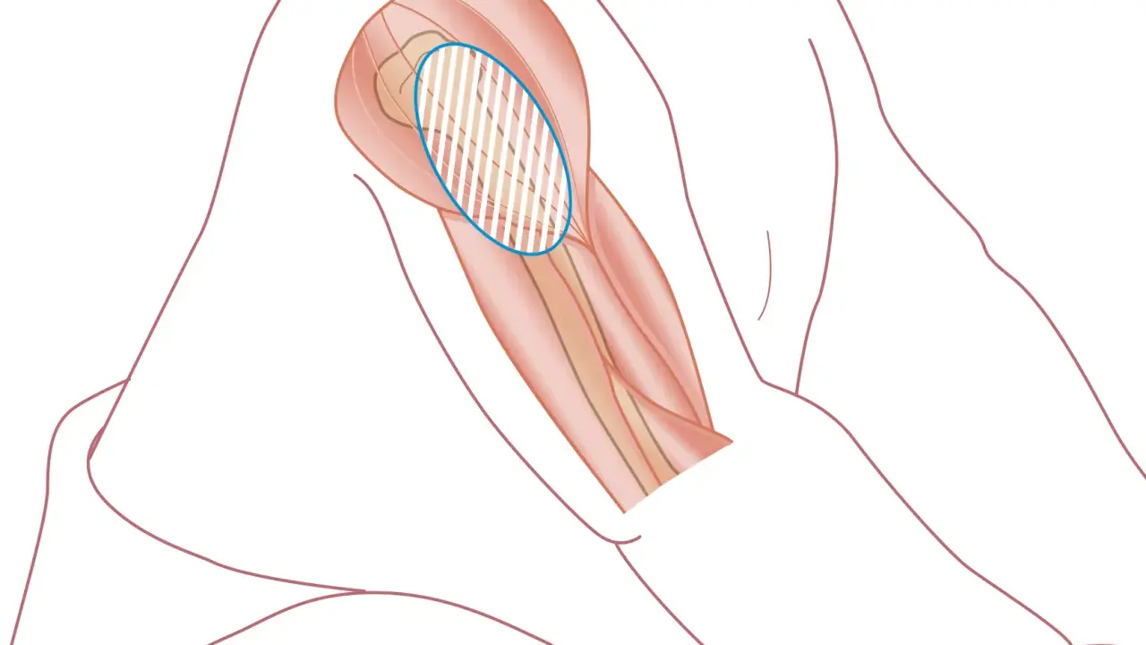 Illustration av en arm med markerad muskel där det kan kännas ont i armen efter tbe vaccination.