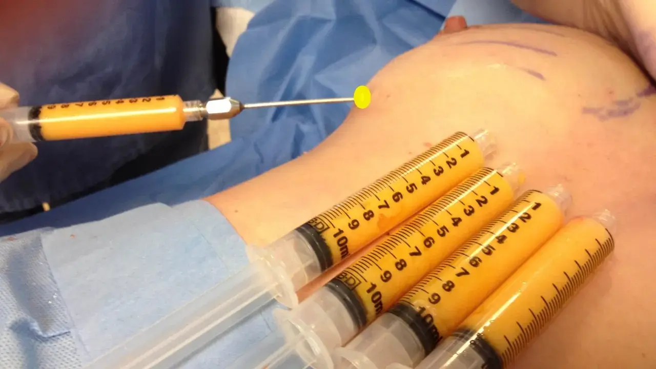 Lipofilling seno: pro e contro. Siringhe piene di grasso aspirato pronte per il rimodellamento del seno.
