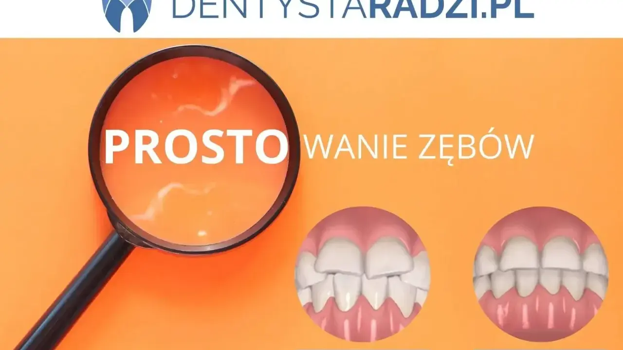 Proste licówki na krzywe zęby. Porównanie uśmiechu przed i po zabiegu.
