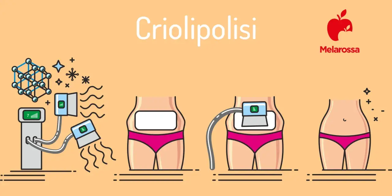 Illustrazione della criolipolisi: il processo, i benefici e i possibili criolipolisi effetti collaterali.
