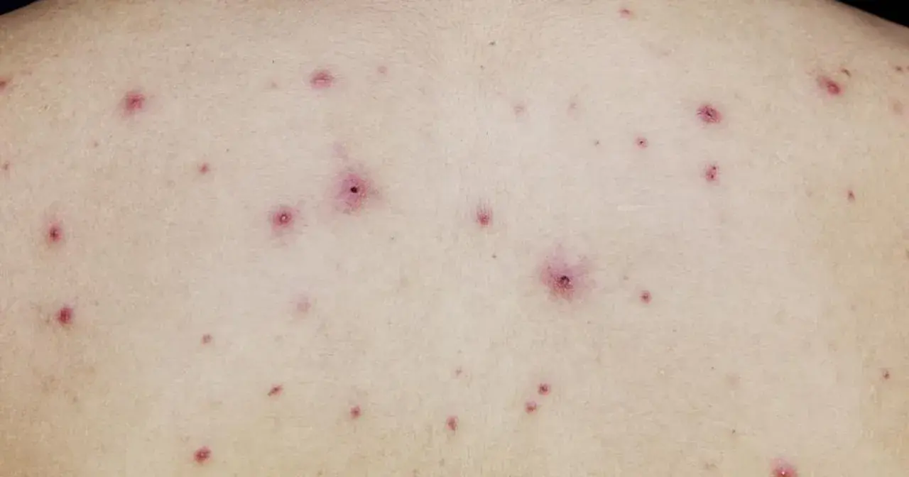 Skóra z licznymi, czerwonymi krostkami i grudkami. To mogą być ospa początki, zwiastujące chorobę.
