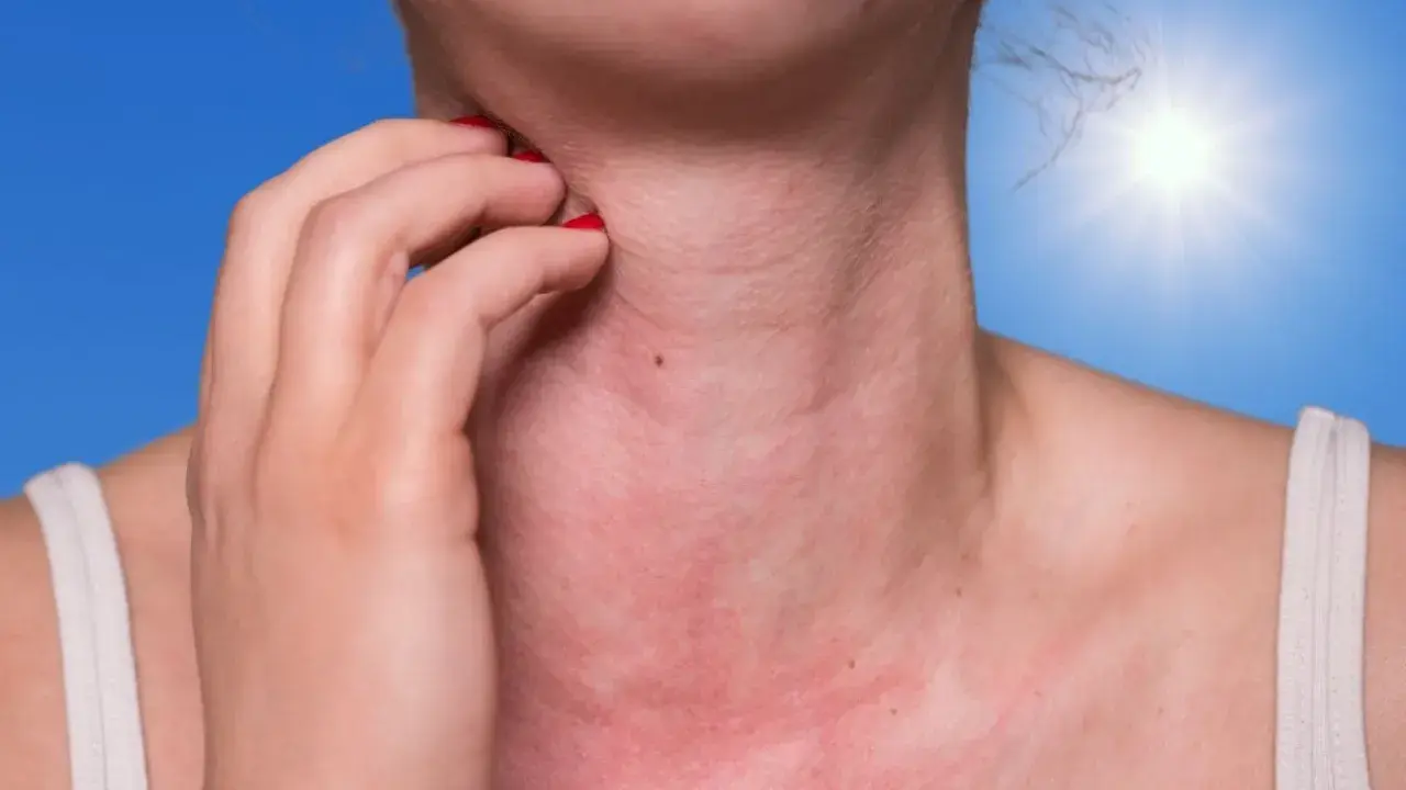 Une personne se gratte le cou rouge et irrité, peut-être à cause de boutons de soleil sur le visage et le corps. Le soleil brille intensément en arrière-plan.