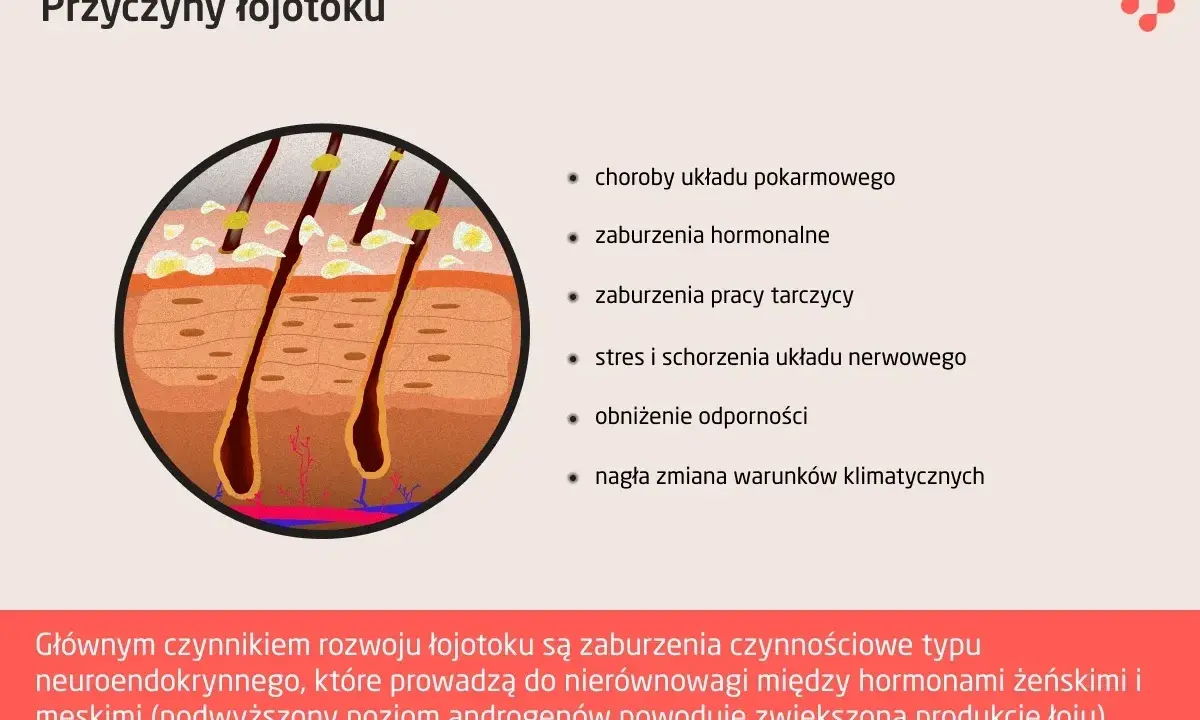 Przekrój skóry z widocznymi gruczołami łojowymi, które mogą powodować rany na skórze głowy z powodu łojotoku.