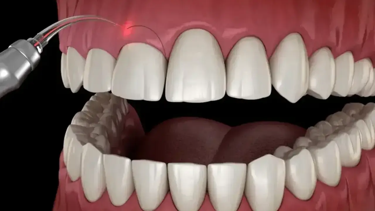 Zabieg gingiwektomii laserem: precyzyjne modelowanie dziąseł dla pięknego uśmiechu.