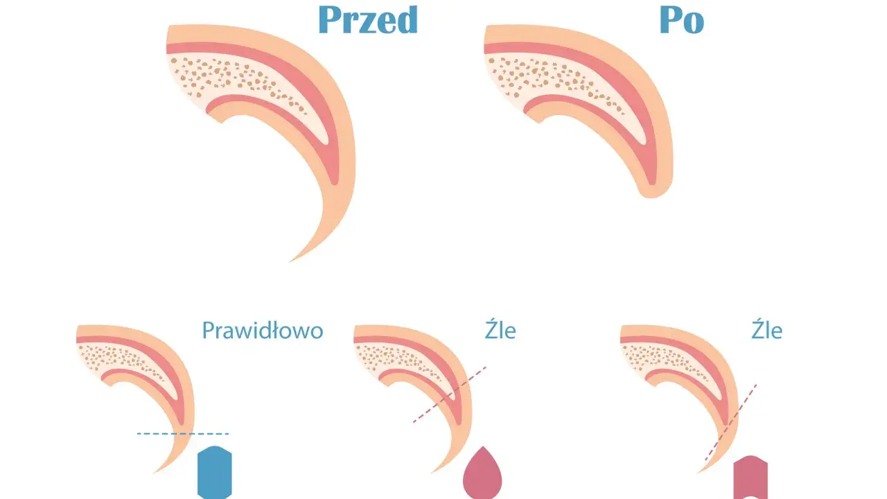 Ilustracja pokazuje przekrój pazura psa przed i po przycięciu. Pokazuje też prawidłowe i nieprawidłowe przycinanie, które może prowadzić do krwawienia.