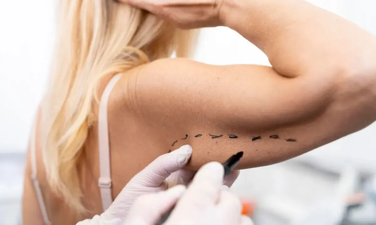 Medico disegna con pennarello su braccio, segnando una nuova tecnica per lifting braccia.