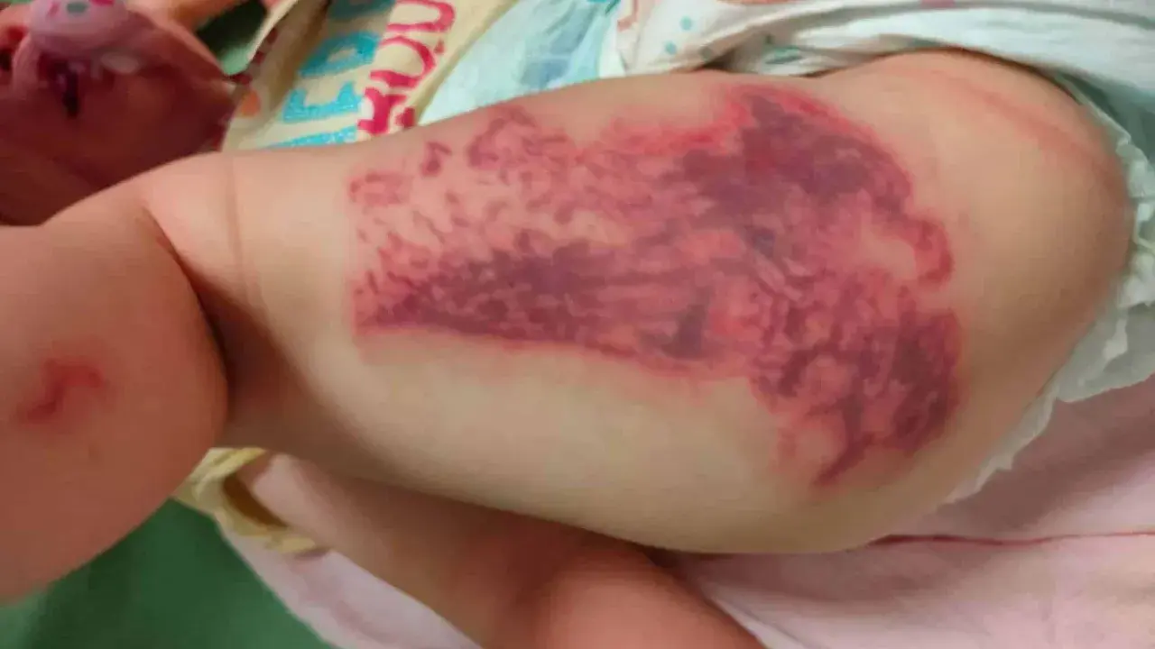 Grossa macchia violacea sulla coscia di un neonato, simile a punture di medusa (quallenstich punkte).