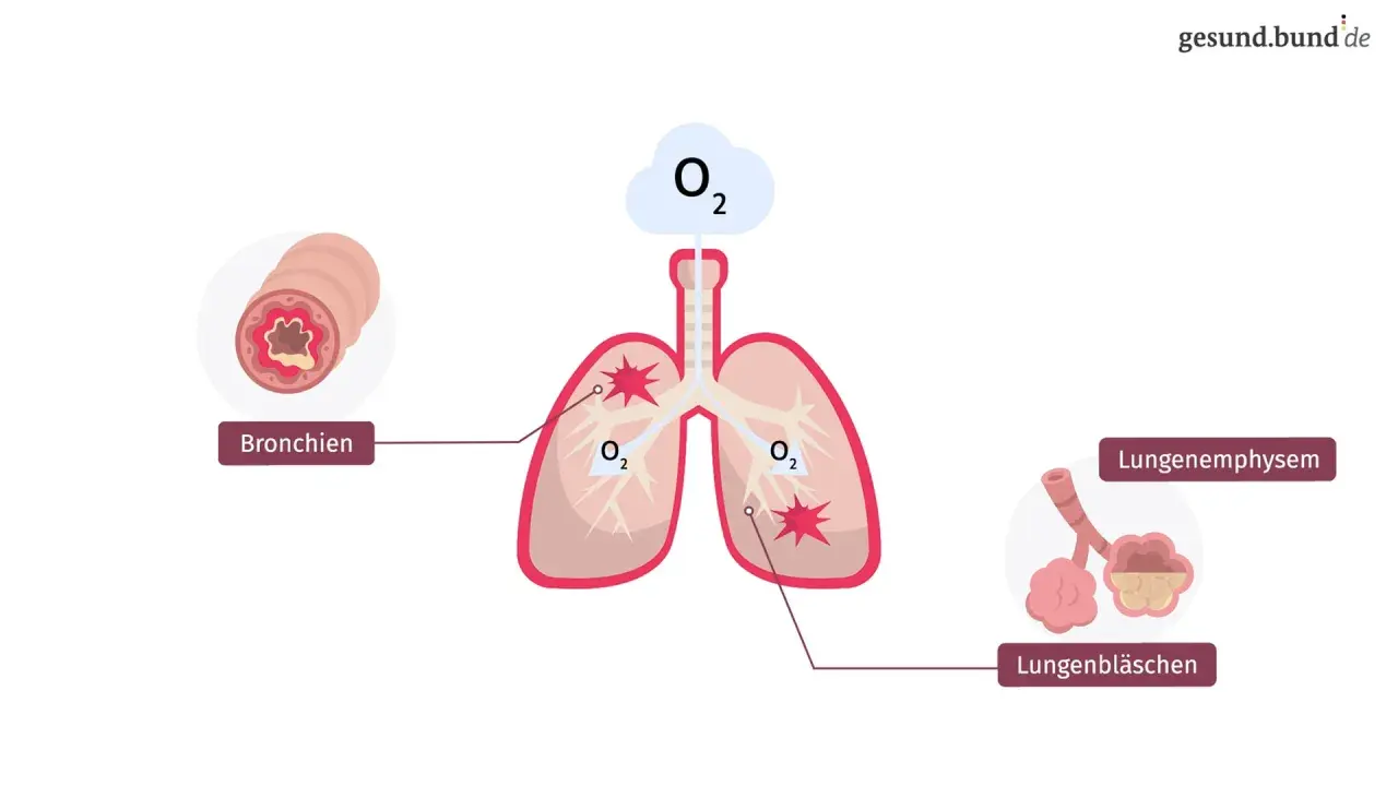Darstellung der Lunge mit entzündeten Bronchien und zerstörten Lungenbläschen, typisch für COPD bei Rauchern.