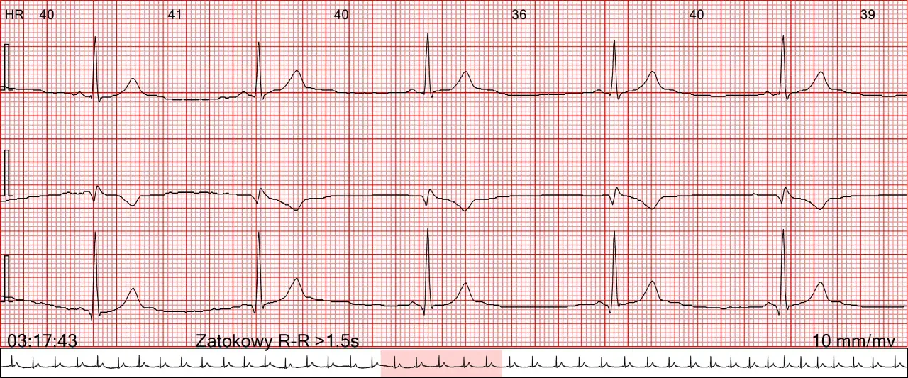 EKG z zapisem rytmu zatokowego. Widoczne są fale serca z zaznaczonymi odstępami R-R >1.5s, wskazującymi na bradykardię.