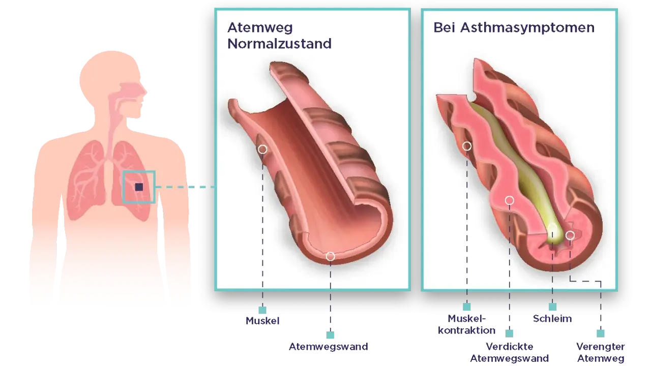 Vergleich von Atemwegen: Normalzustand vs. bei Asthmasymptomen. Bei unkontrolliertem Asthma verengen sich die Atemwege durch Muskelkontraktion und Schleimbildung.