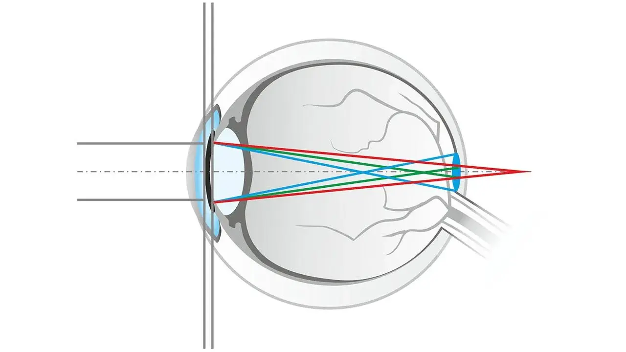 Schéma de l'œil montrant la réfraction des rayons lumineux rouge, vert et bleu. La lumière bleue est plus déviée, illustrant qu'est ce que la lumière bleue.