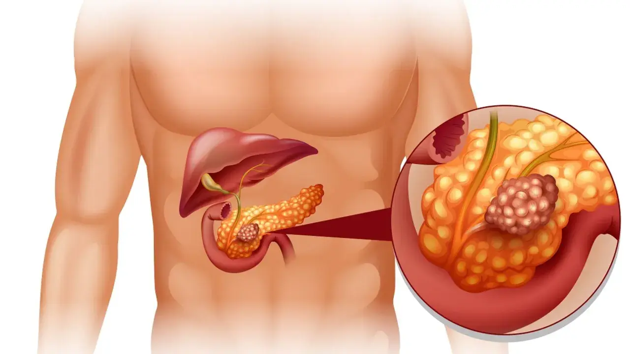 Ilustracja anatomiczna przedstawiająca trzustkę z guzem nowotworowym.