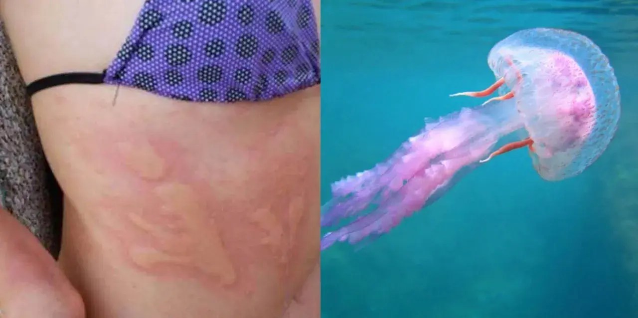 Pelle arrossata con segni di una **piqûre meduse** e una medusa rosa trasparente che nuota nell'acqua blu.