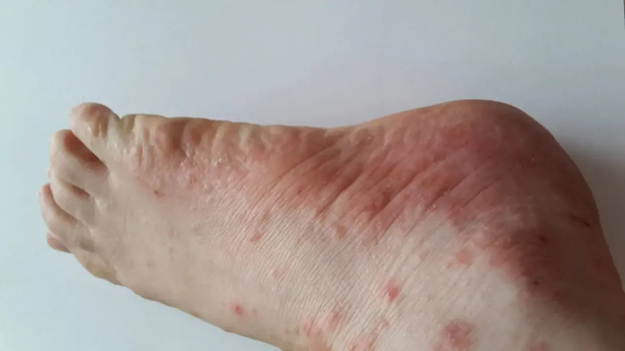 Pieds présentant des rougeurs et des petits boutons qui grattent, signe d'une irritation cutanée.