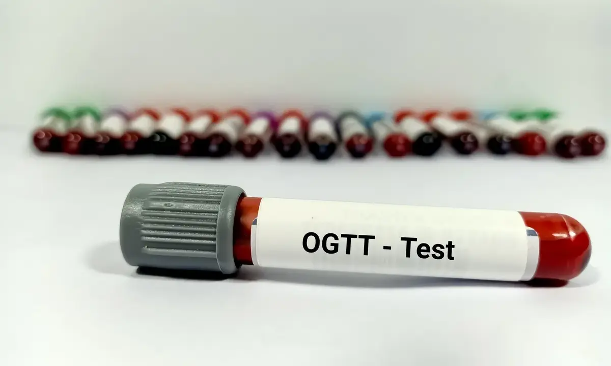 Probówka z oznaczeniem "OGTT - Test" na tle wielu innych próbek krwi. To ważny etap w diagnostyce cukrzycy, czyli test obciążenia glukozą.