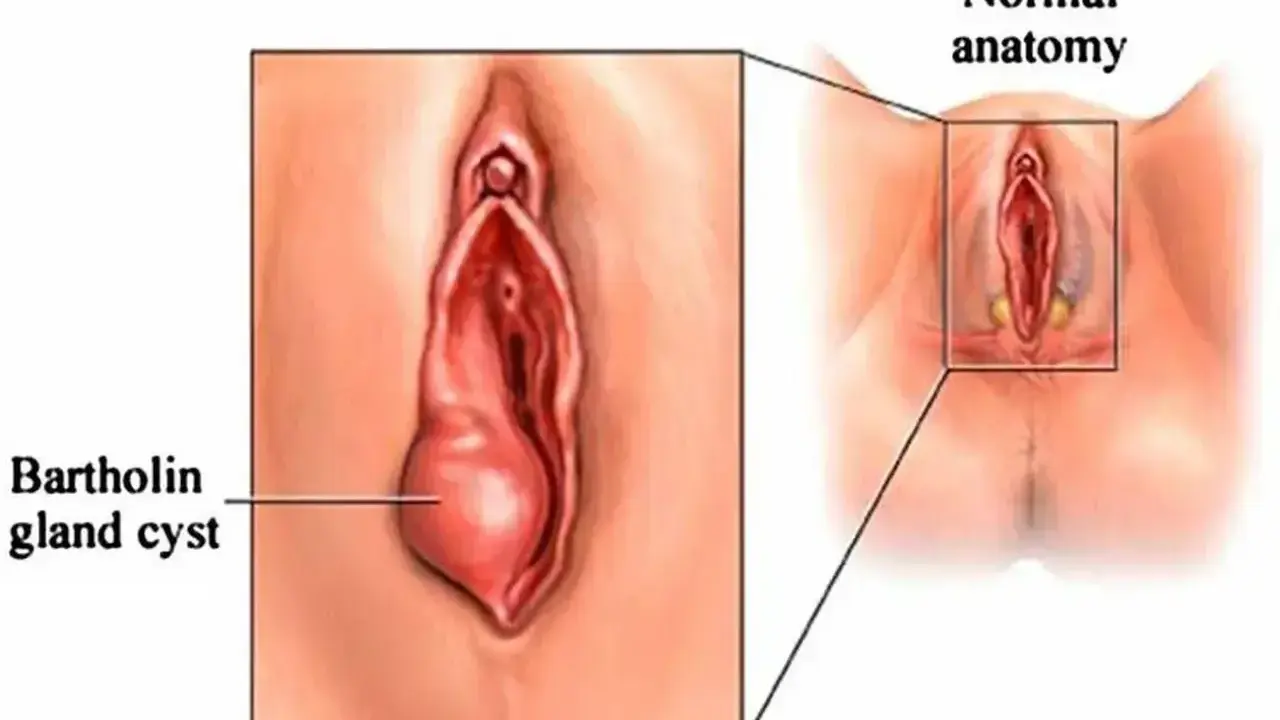 Ilustracja pokazuje zapalenie gruczołu Bartholina jako powiększoną torbiel po lewej stronie, w porównaniu do prawidłowej anatomii po prawej.