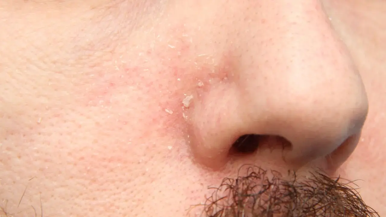 Pelle arrossata e desquamata intorno al naso, sintomo di dermatite seborroica.