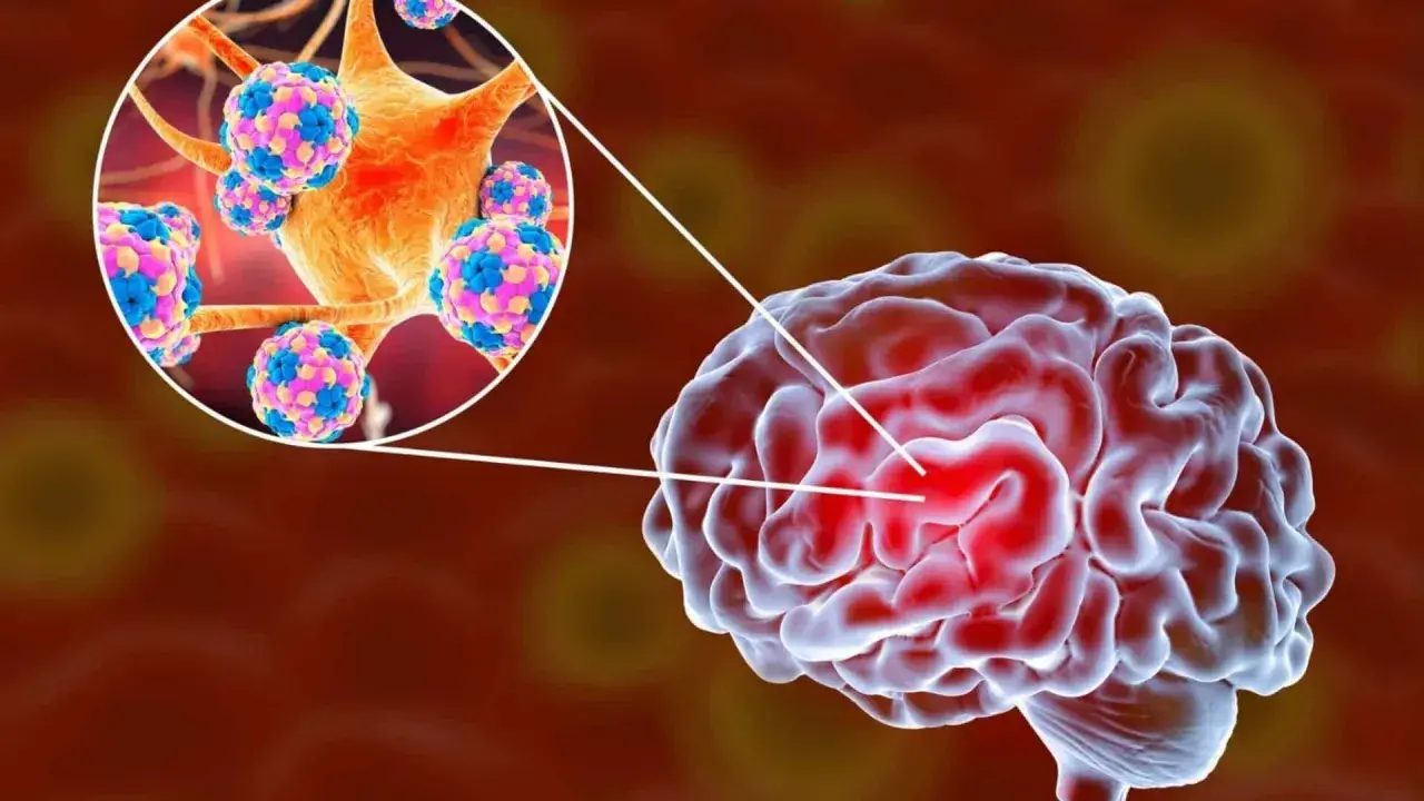 Illustration av hjärnan med en förstorad vy av virus som orsakar hjärnhinneinflammation.