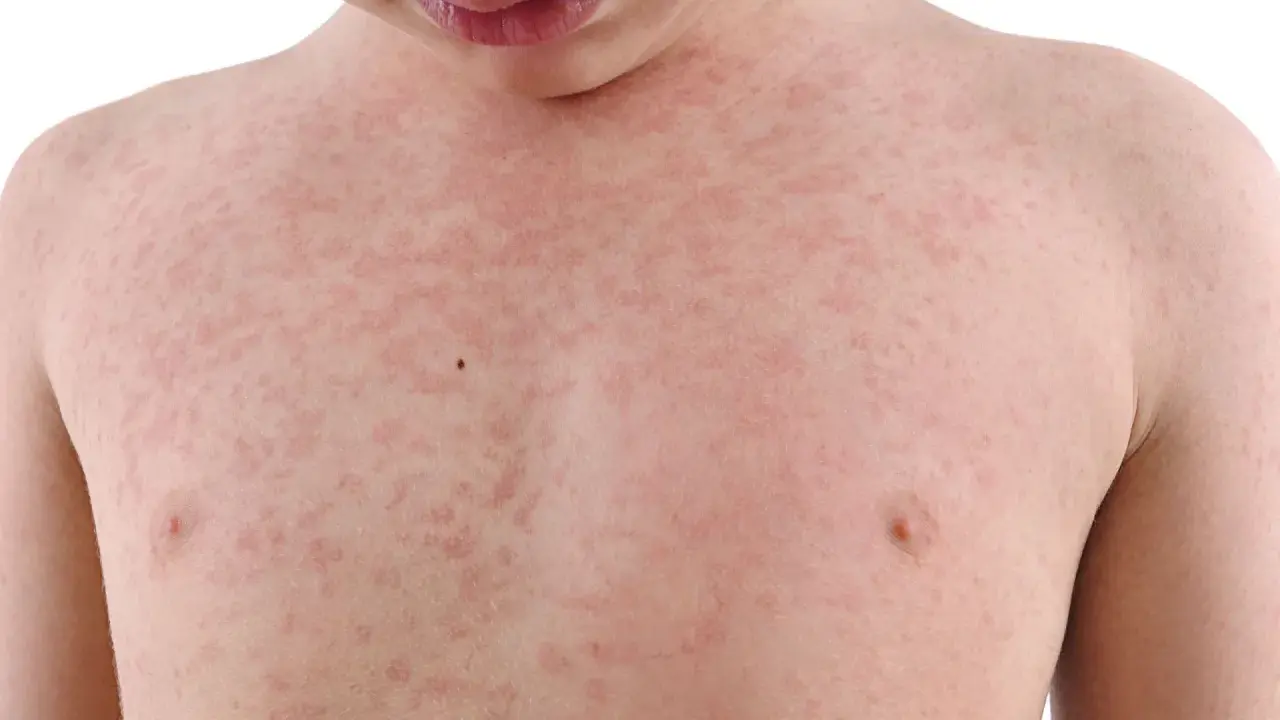 Dziecko z wysypką na klatce piersiowej, która może być objawem alergii wziewnej.