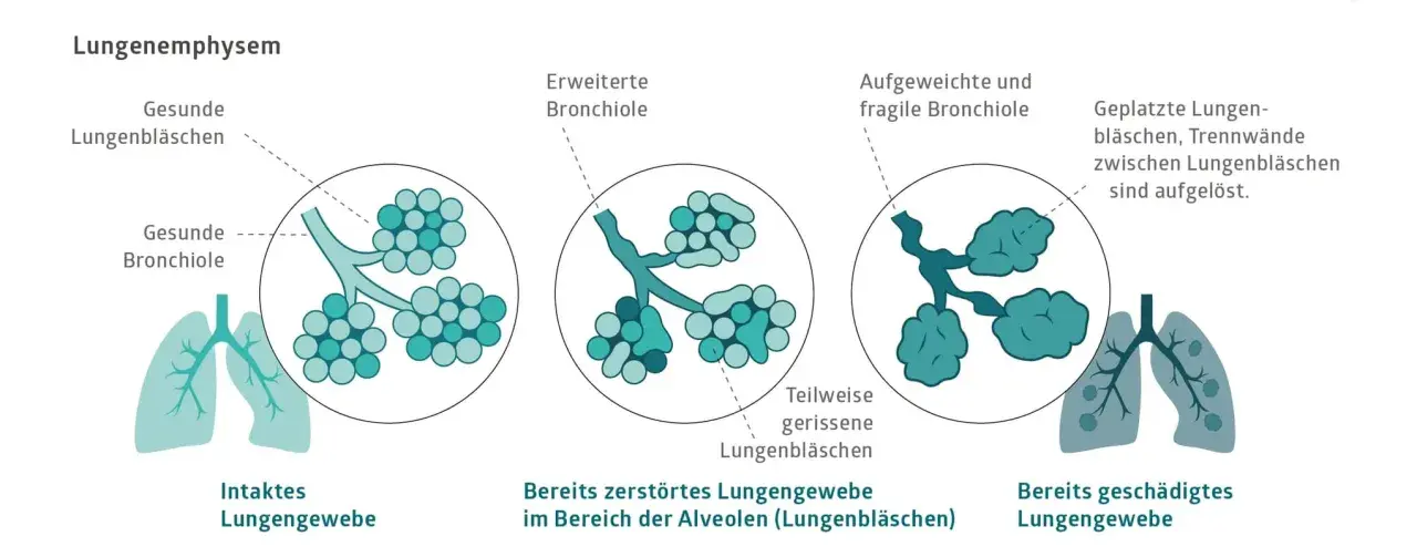 Veranschaulicht die Zerstörung von Lungenbläschen bei COPD, auch ohne Rauchen. Zeigt gesunde, erweiterte und geplatzte Lungenbläschen.