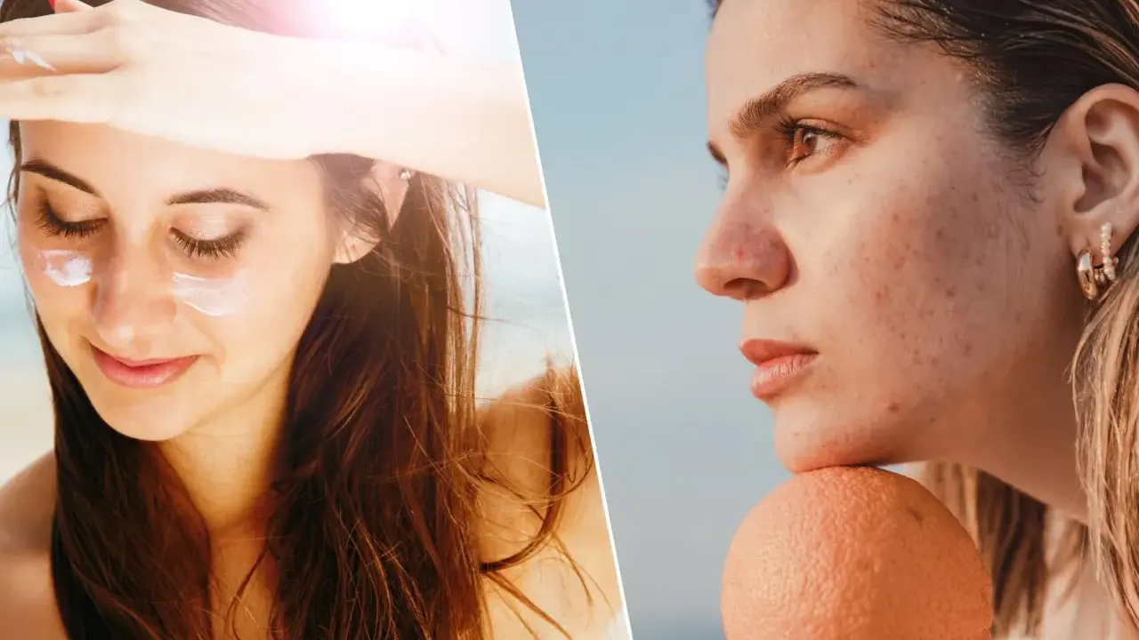 Visage protégé du soleil avec crème, puis profil avec acné et taches, une cicatrice soleil peut apparaître sans protection.