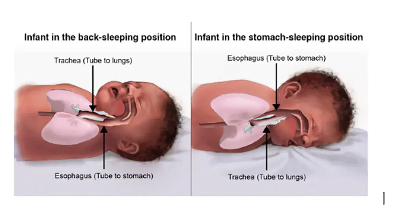 Illustrazione anatomica che mostra come far addormentare un neonato in posizione supina, con trachea e esofago liberi.