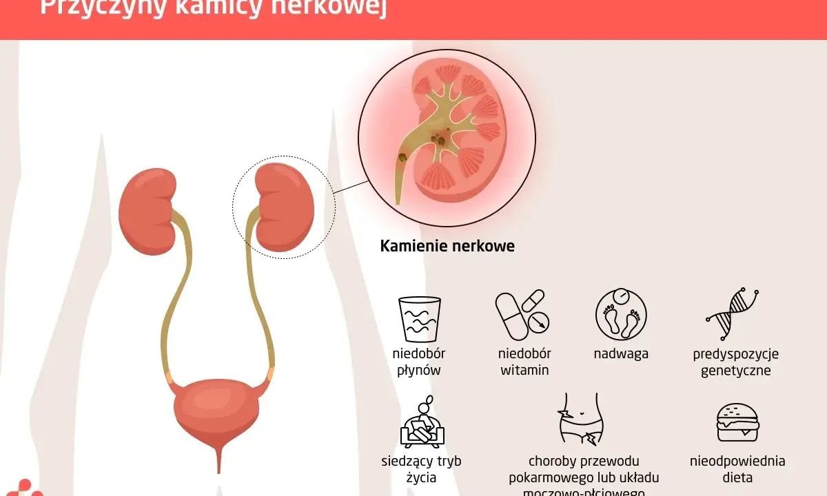 Ilustracja przedstawia przyczyny kamicy nerkowej, w tym kamienie nerkowe, niedobór płynów, witamin, nadwagę, siedzący tryb życia, choroby układu pokarmowego i nieodpowiednią dietę.